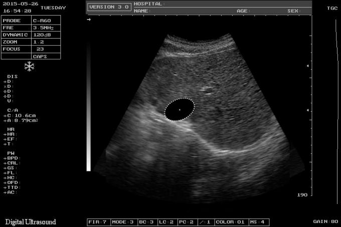 USG OB GYN Portable USG Machine IMT Automatic Measurement